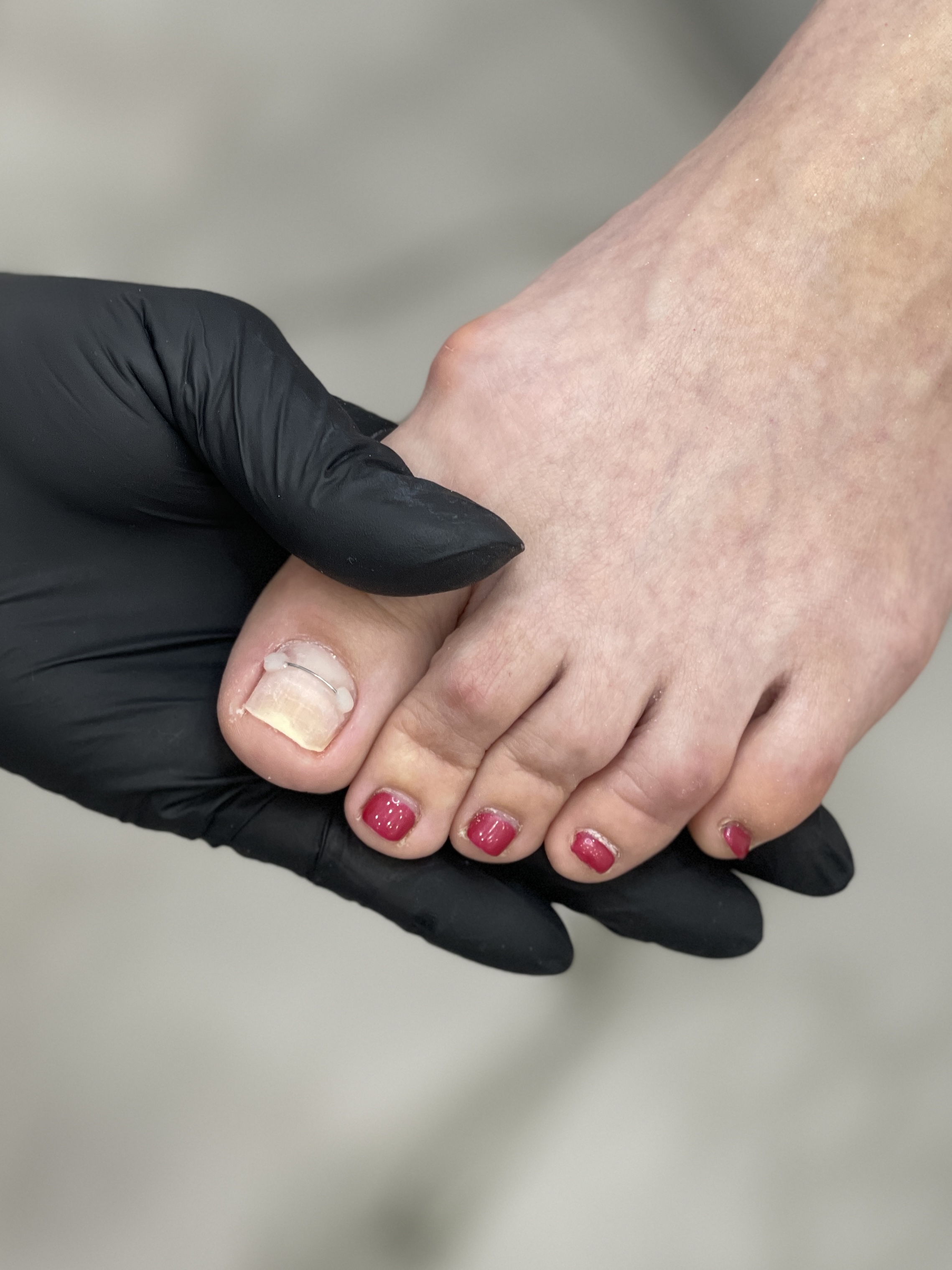 Коррекция вросших ногтей титановой нитью